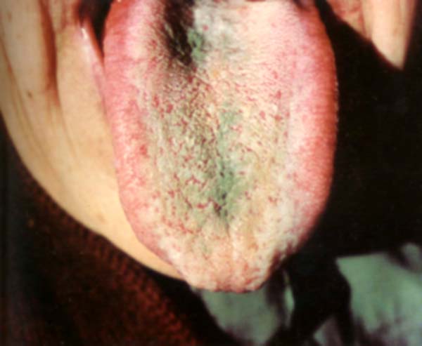 淡红舌边白腻中绿苔