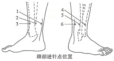 腕踝针进针点及其适应证